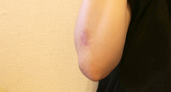 当院の傷跡・ケロイド・瘢痕の修正治療の特徴
